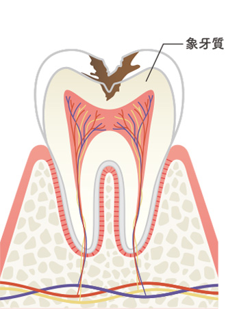 画像：むし歯の進行レベルと症状3