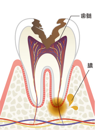 画像：むし歯の進行レベルと症状5