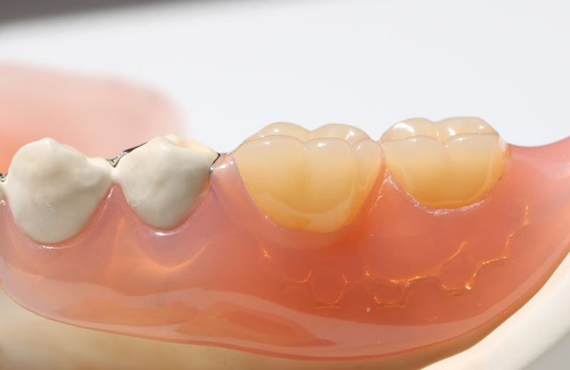 画像：入れ歯