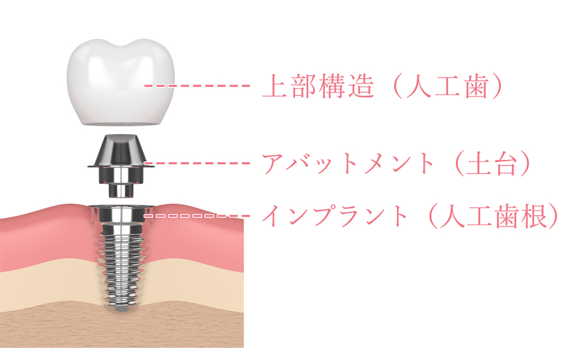 画像：インプラント