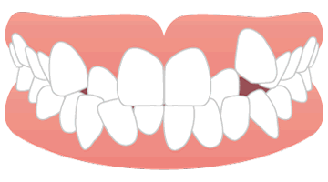 画像：噛む力の不足
